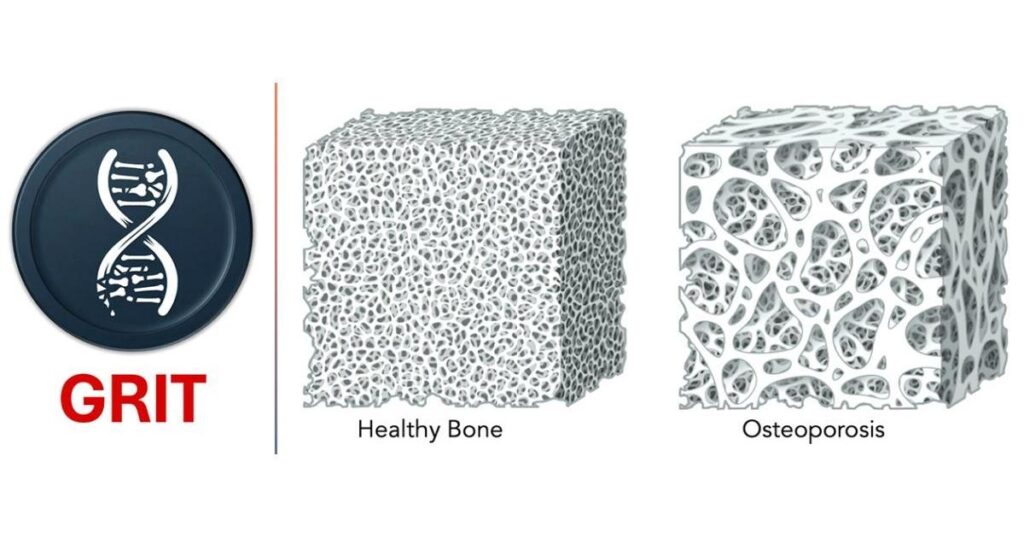 Seeking GRIT to understand the genetics of osteoporosis